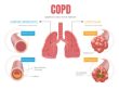 COPD