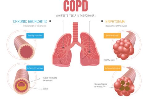 COPD